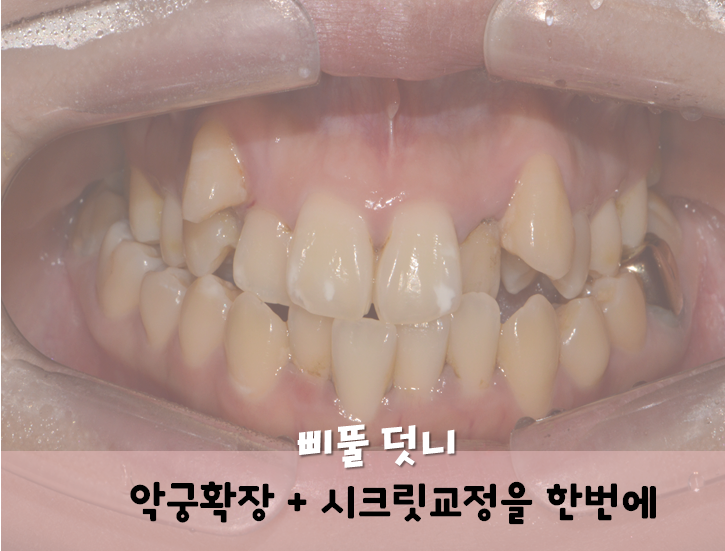 덧니 교정, 악궁 확장장치, 쁘띠 교정_신논현역 아름드리치과 관련 이미지 2