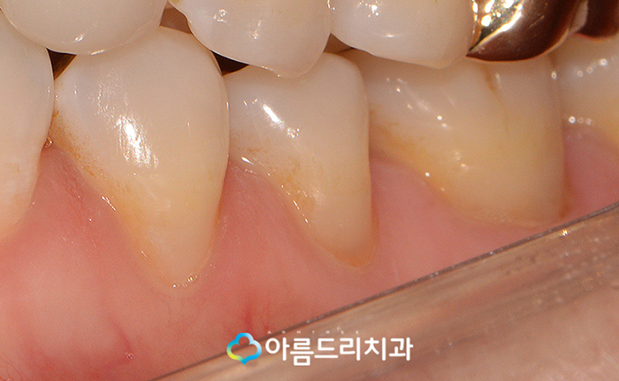 치경부마모증 잇몸파임 시린이 치료 관련 이미지 7