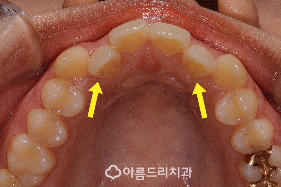 앞니부분교정기간 후기의 변화 관련 이미지 5