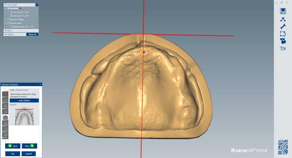 [신논현 치과] 3D 구강 스캐너_정확하게 본뜨기 관련 이미지 4