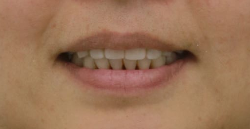 왜 임플란트와 치아교정을 다 잘아는 곳에서 치료해야할까?| 아름드리치과 진료일기 관련 이미지 8