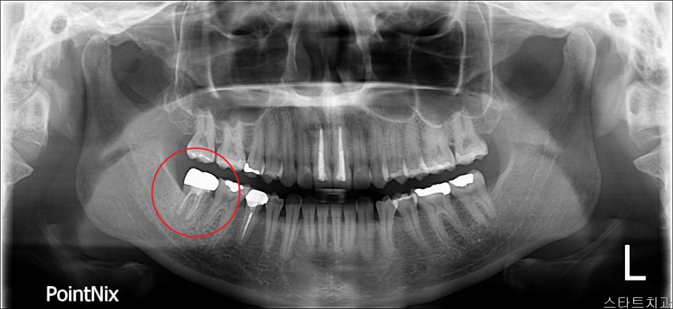 [신논현 치과] 임플란트 대신 치아재식(아름드리치과) 관련 이미지 3