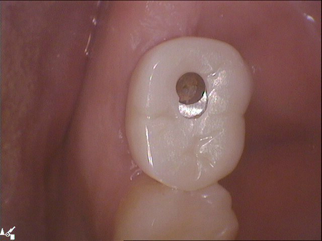 임플란트 구멍(홀)이 났는데 어떻하죠? 관련 이미지 4