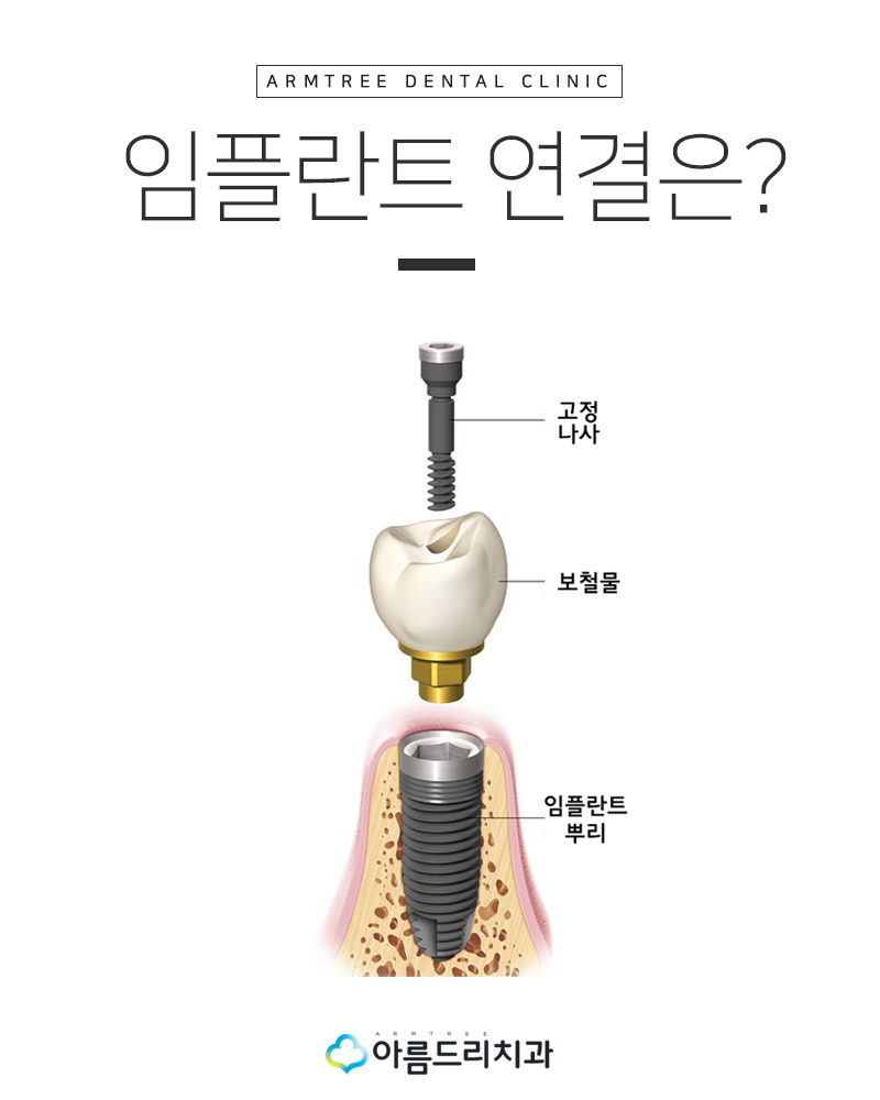 임플란트 구멍(홀)이 났는데 어떻하죠? 관련 이미지 6