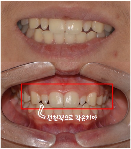 앞니 라미네이트_왜소치아 (최소삭제) 관련 이미지 2