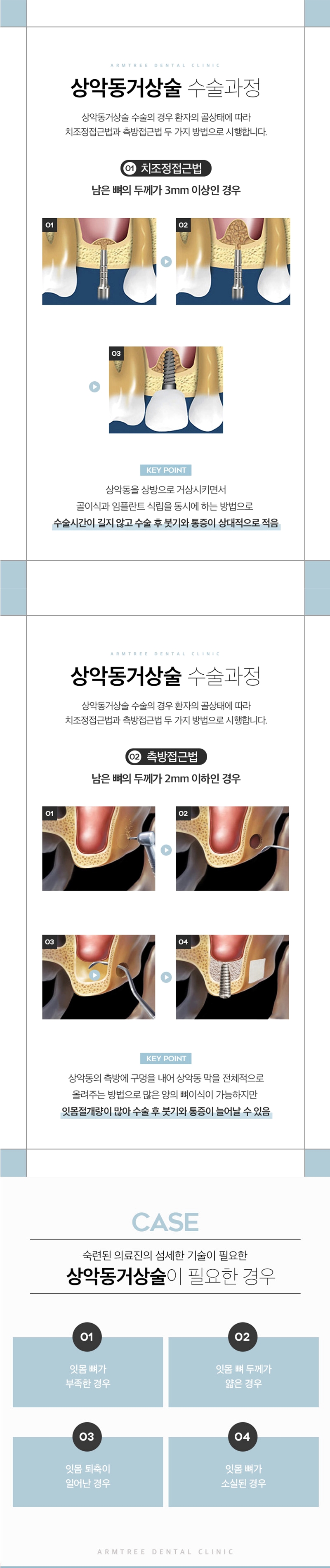 반포치과 임플란트 상악동거상술이 필요하다면 관련 이미지 2