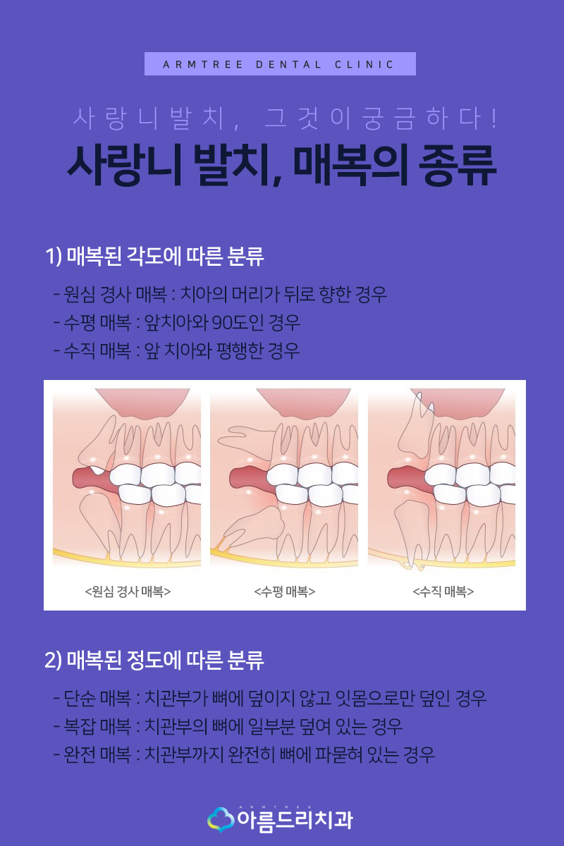 매복사랑니발치치과 경험이 중요해 관련 이미지 5