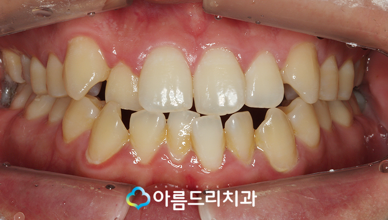 투명교정장치 인비절라인 치과 후기 관련 이미지 3