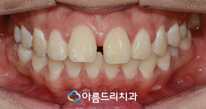 벌어진앞니 앞니라미네이트 치료후기 관련 이미지 5