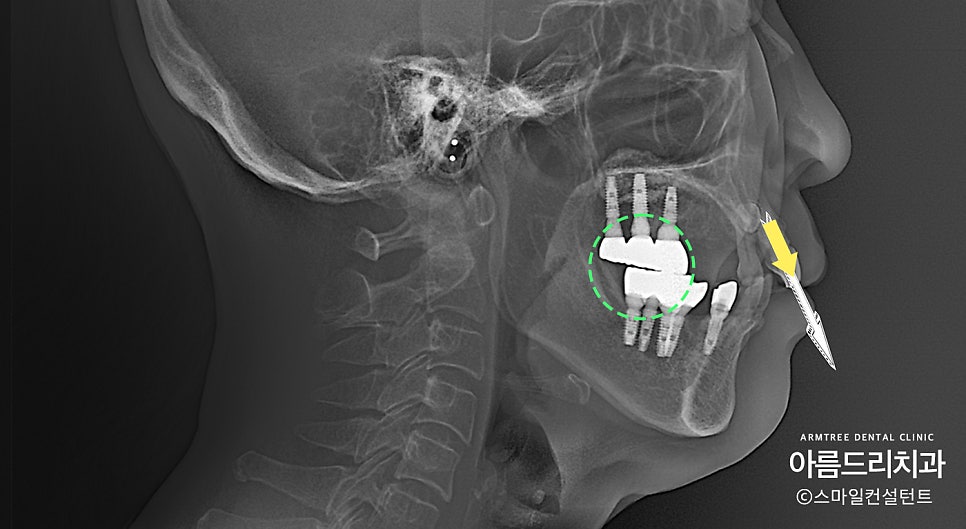 임플란트 심미보철 전후 아름드리치과 진료일기 관련 이미지 6