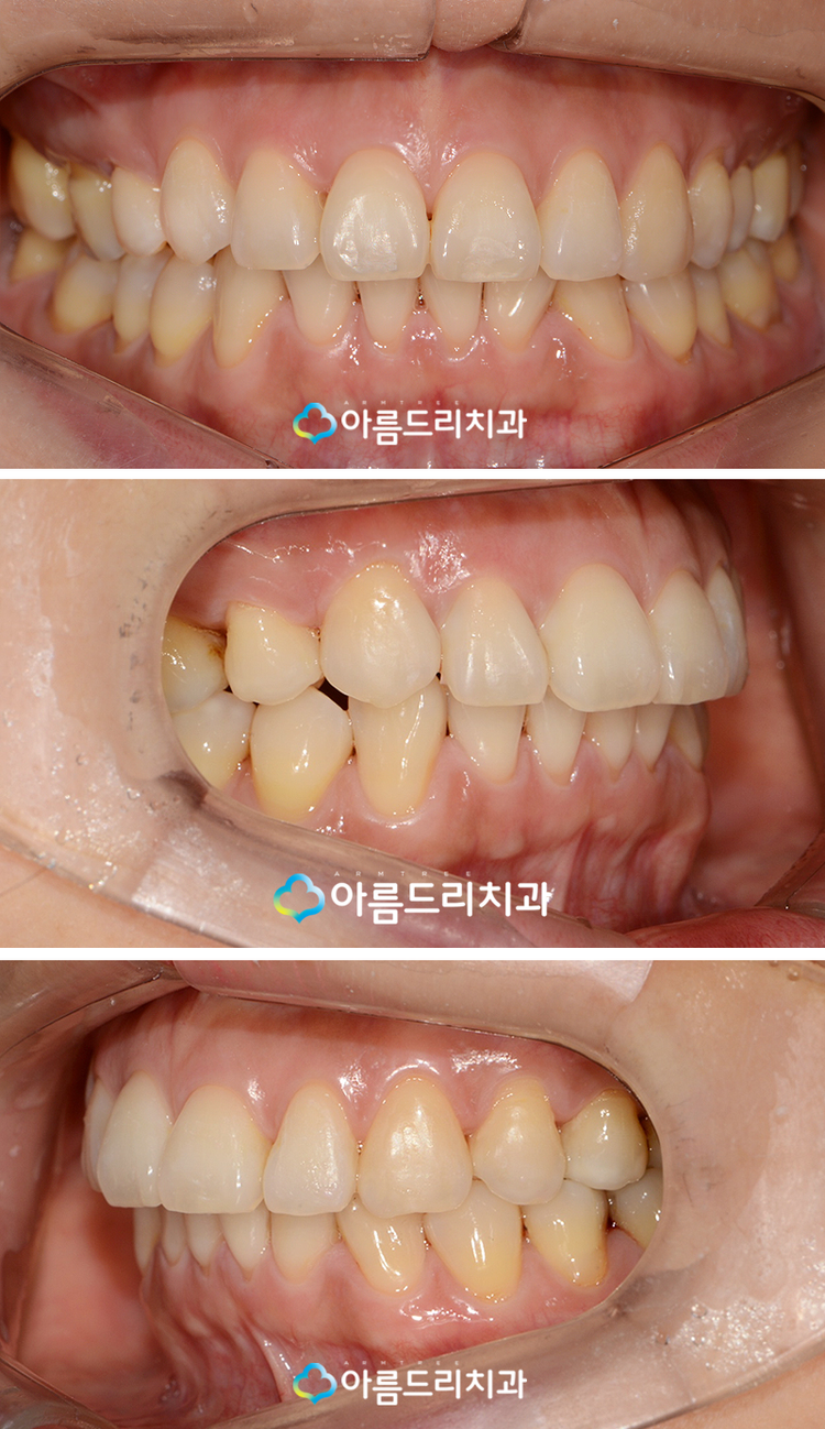 설측교정 후기앞니 단기간에 관련 이미지 7