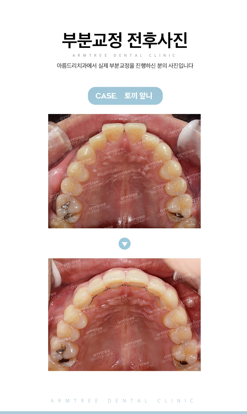 돌출앞니부분교정 빠르게 신논현역 아름드리치과 관련 이미지 12