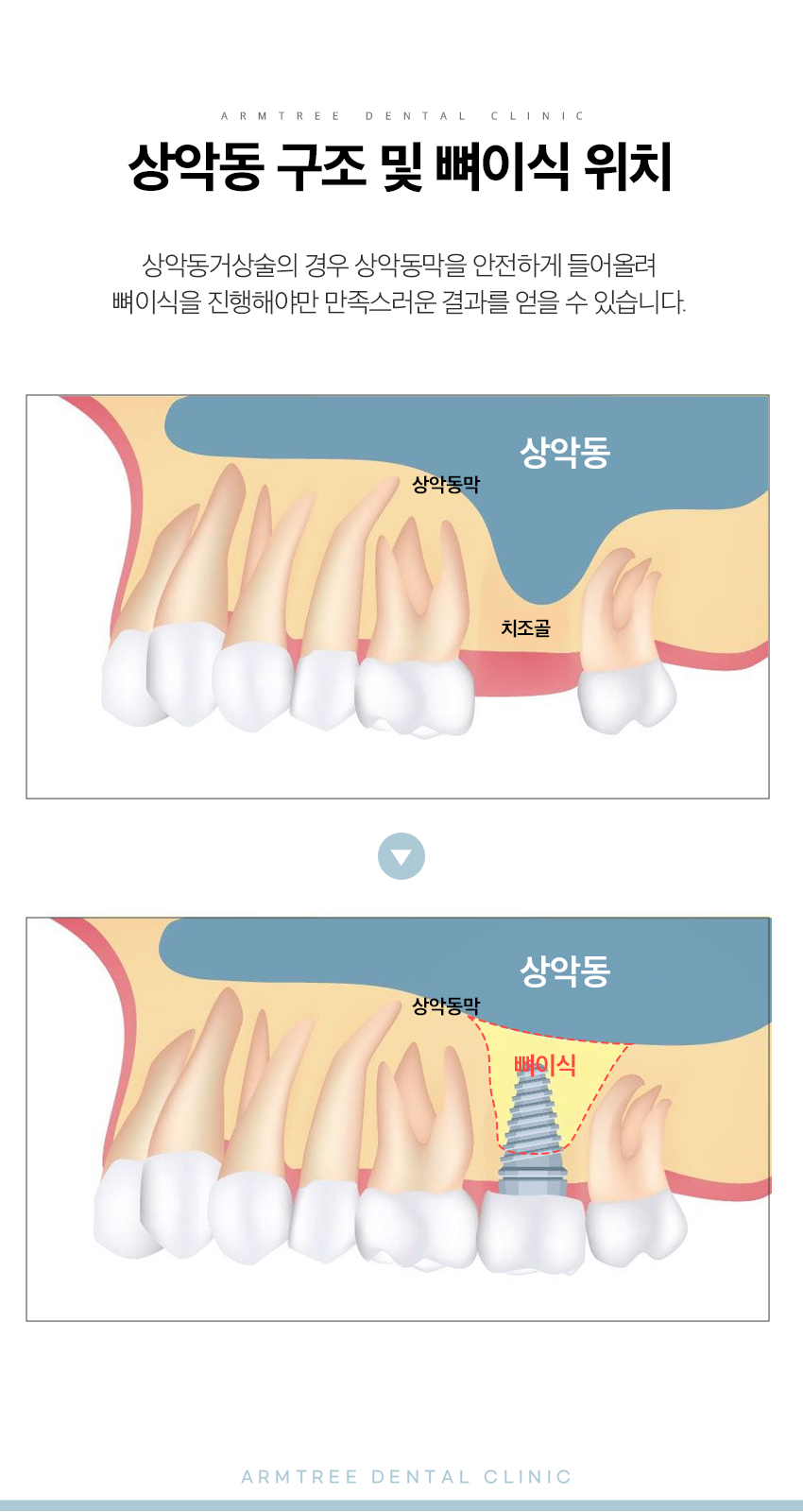 임플란트재수술 상악동거상술 부작용 케이스 진료일기 관련 이미지 6