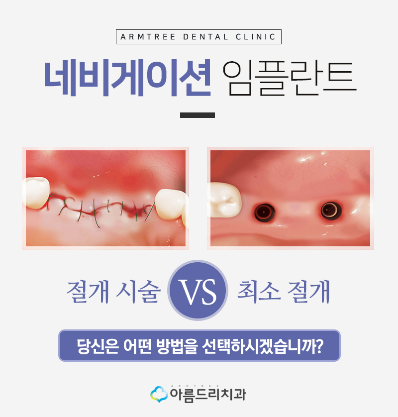인플란트통증 걱정없는 디지털임플란트 관련 이미지 4
