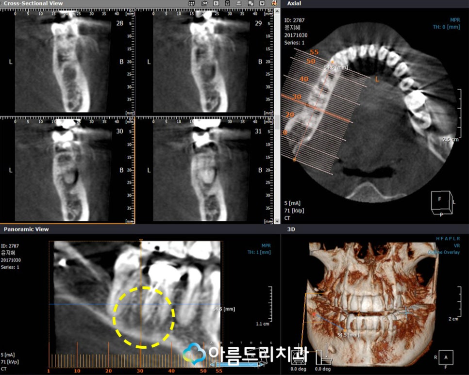 잇몸고름주머니 잇몸에고름 치아재식술 치료 관련 이미지 4