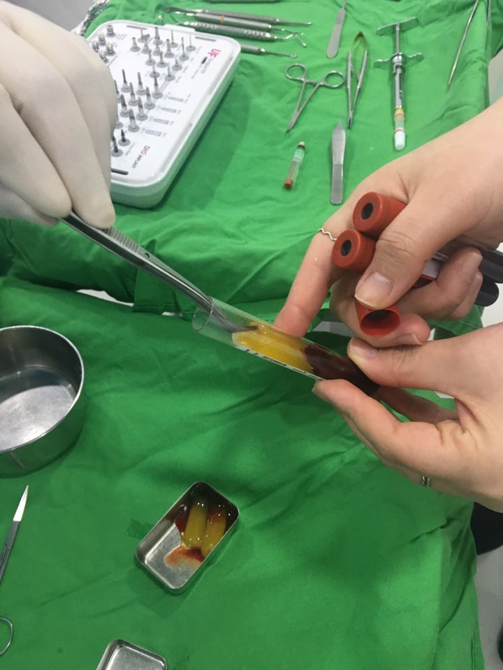 신논현역치과 PRF 자가혈 임플란트. 안전한 임플란트_아름드리 치과 관련 이미지 10