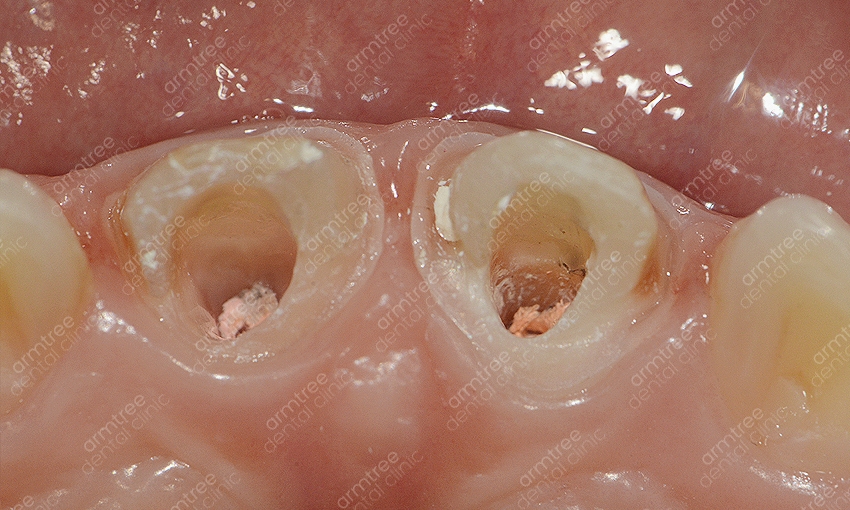 실활치미백 앞니변색 걱정없는 아름드리치과 관련 이미지 7