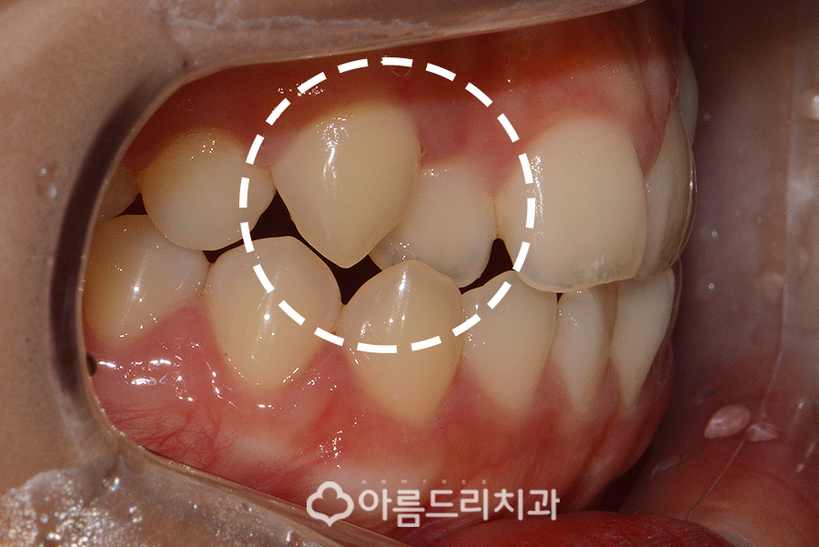 앞니부분교정기간 후기의 변화 관련 이미지 3