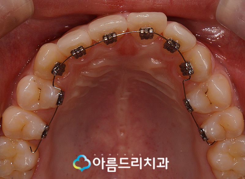 부분 설측교정비용 후기가 좋은 치과 관련 이미지 6
