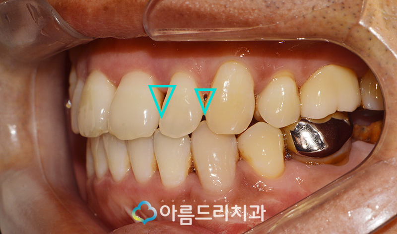 앞니 블랙트라이앵글 치아 이성형으로 해결 관련 이미지 6
