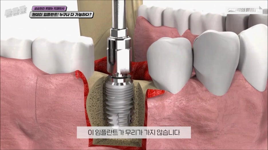 원데이임플란트 누구나 가능하다? #이현정의물음표 관련 이미지 10