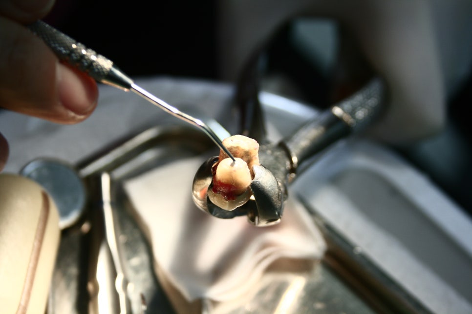 치아재식_임플란트 안 하고 치아 살릴 순 없나요?(신논현역 치과) 관련 이미지 1