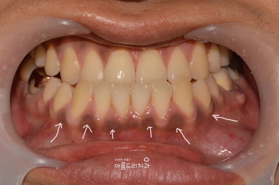 검은 잇몸! 잇몸미백으로 선홍빛 깨끗하게 관련 이미지 4