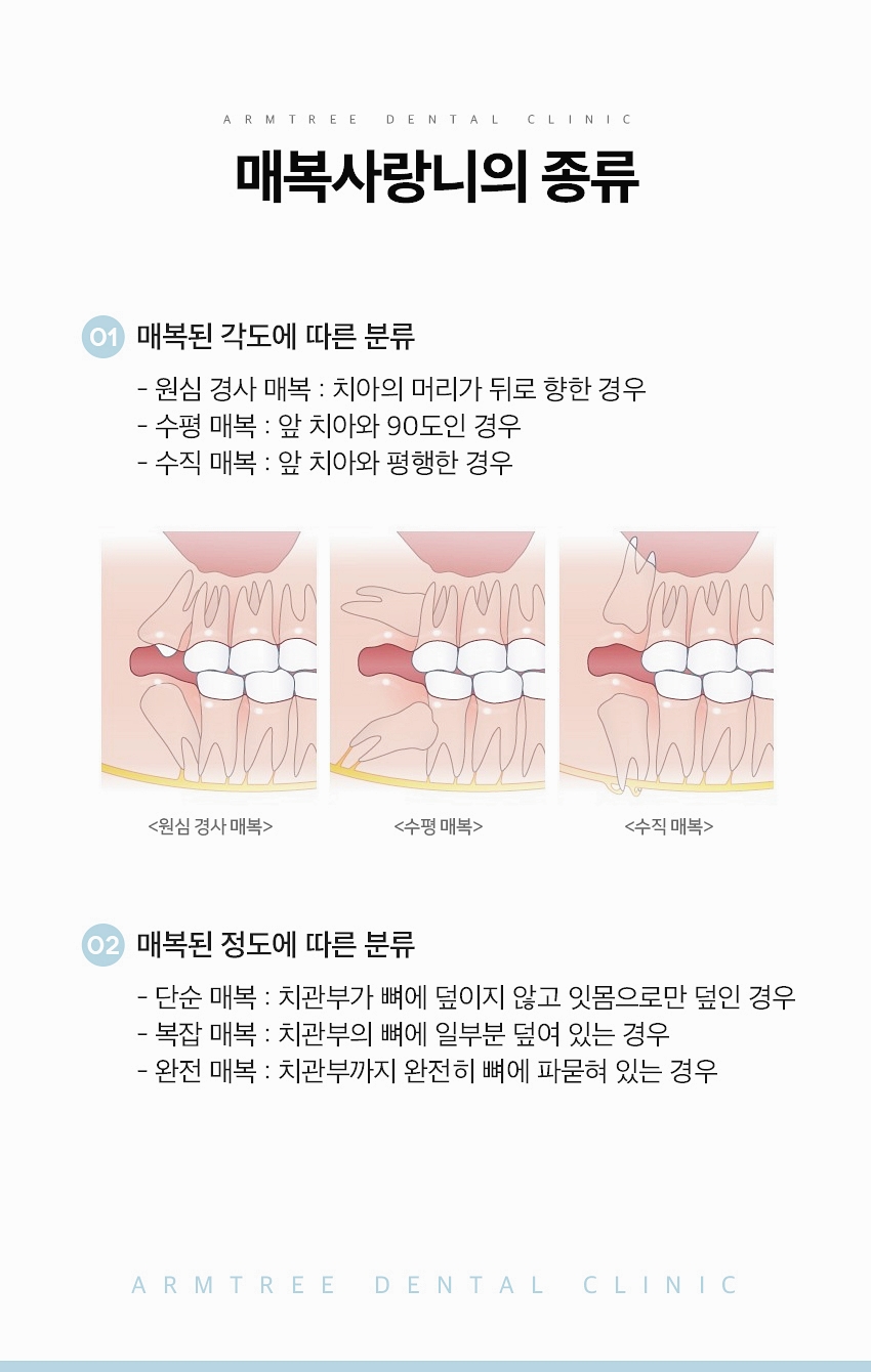 매복사랑니 발치후기 통증없는 아름드리치과 관련 이미지 5