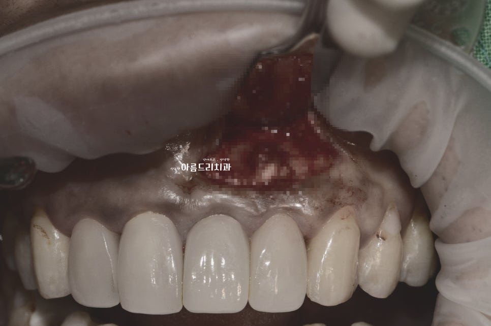 뽑지 않고 자가치아를 살려주세요_치아 뿌리수술_치근단절제술+뼈이식 관련 이미지 2