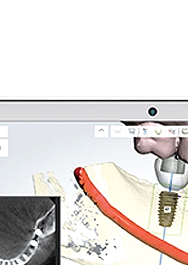 디지털임플란트 당일임플란트로 정확하고 안전하다면 관련 이미지 7