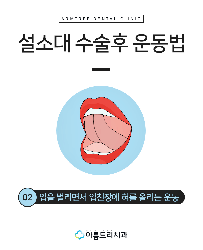 설소대단축증 - 단설소대증의 치료과정 관련 이미지 11