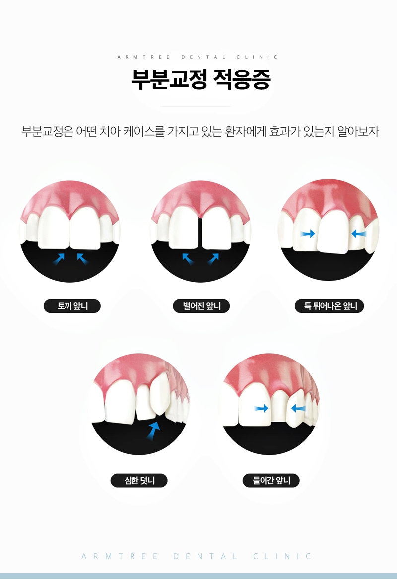 벌어진앞니교정 부분만 효과적으로 아름드리치과 관련 이미지 7