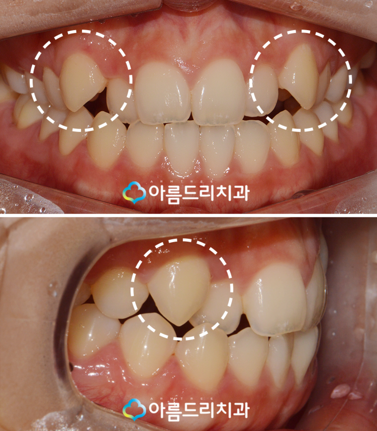 덧니교정 빠르게 부분만 관련 이미지 3