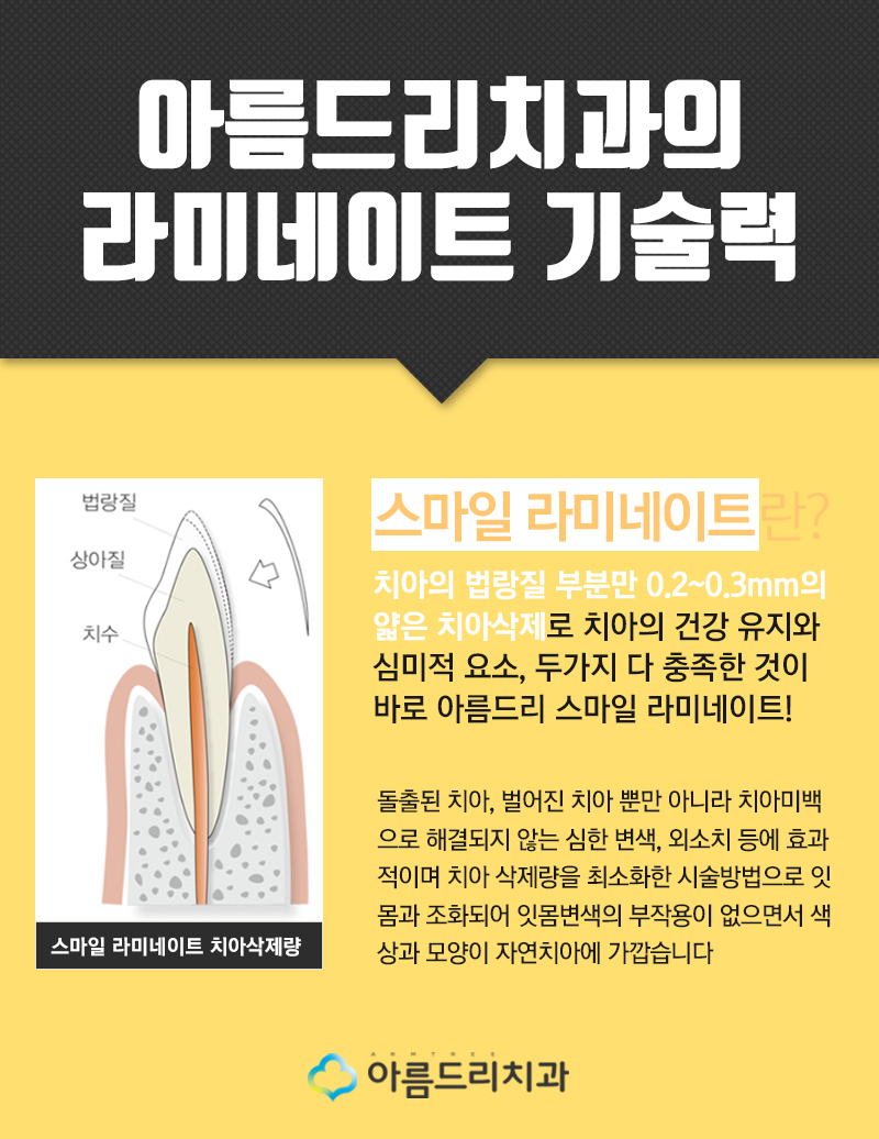 앞니돌출 래미네이트 비용과 가격은? 관련 이미지 4