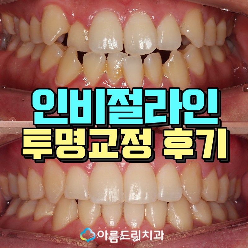 투명교정장치 인비절라인 치과 후기 관련 이미지 1