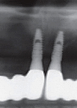 반포치과 전악임플란트는 풀아치 임플란트로 관련 이미지 7