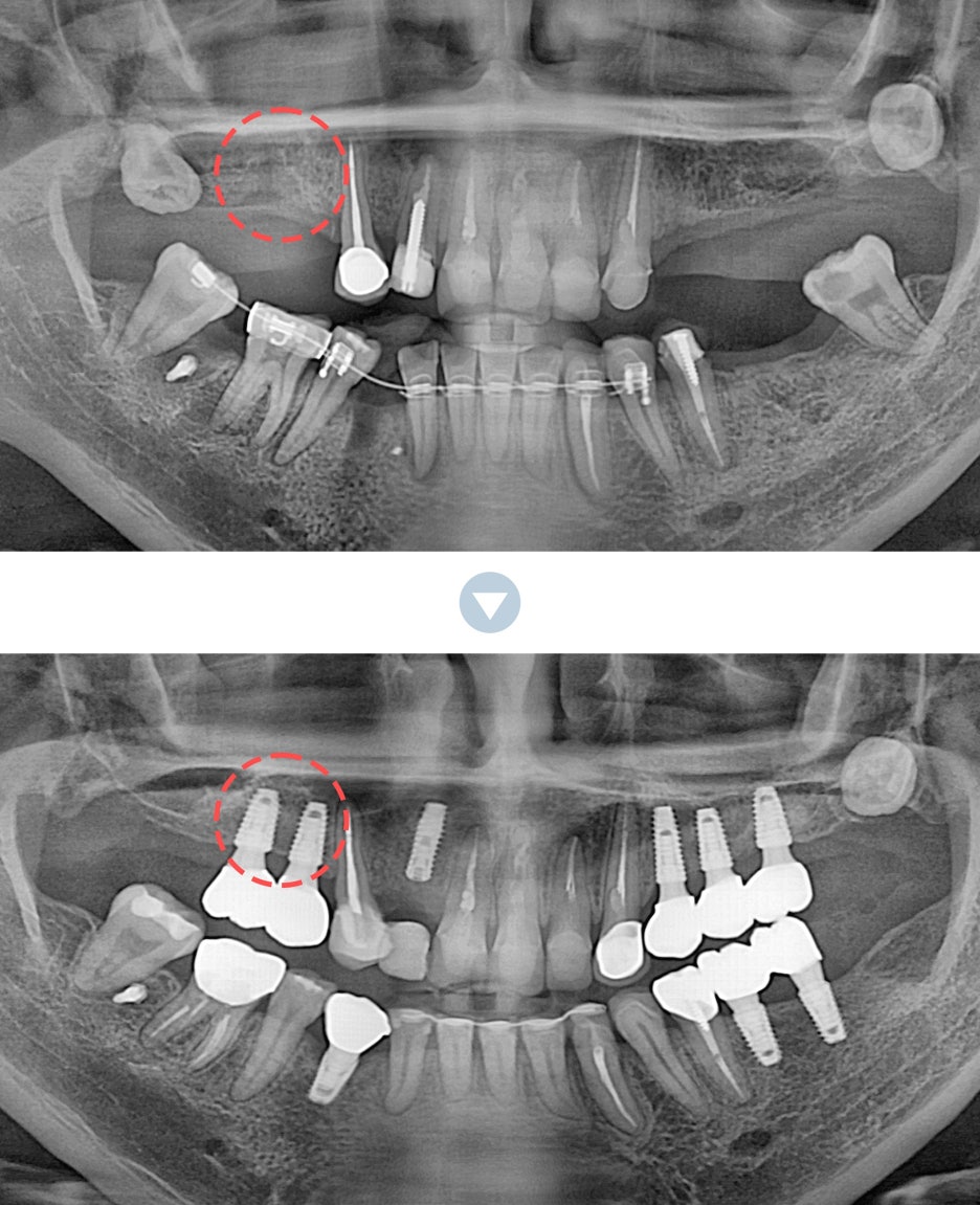 신논현역임플란트 아름드리치과에서 상악동거상술이 필요하면 관련 이미지 5