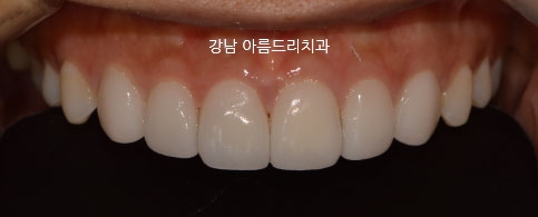 라미네이트,올세라믹으로 연예인치아 (주의사항)_아름드리치과 관련 이미지 12