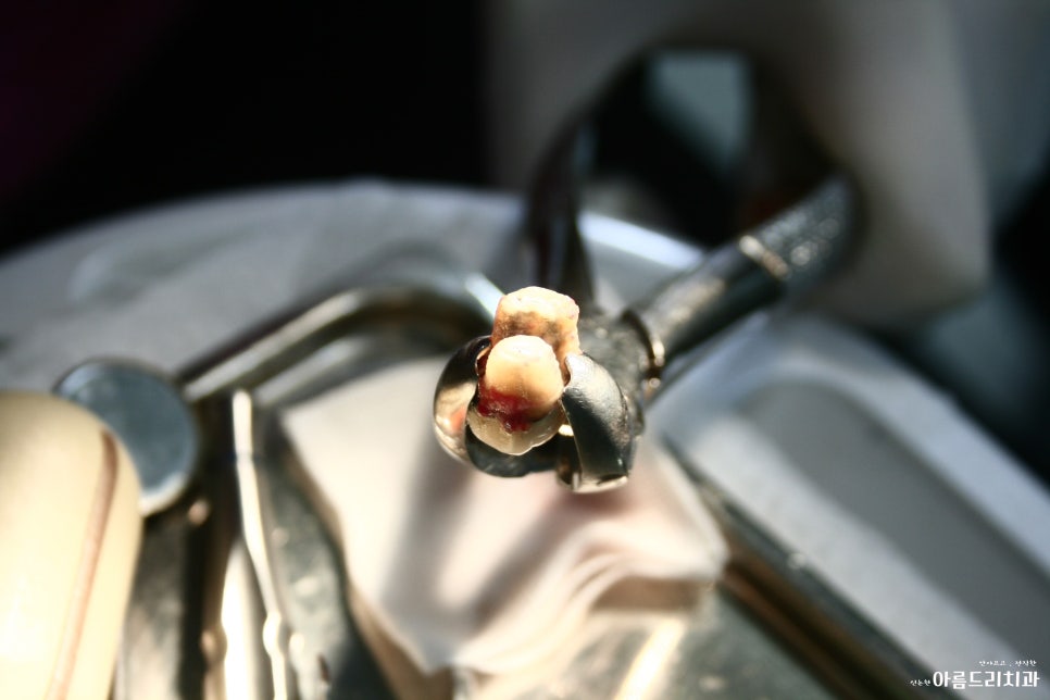 치아재식_임플란트 안 하고 치아 살릴 순 없나요?(신논현역 치과) 관련 이미지 14