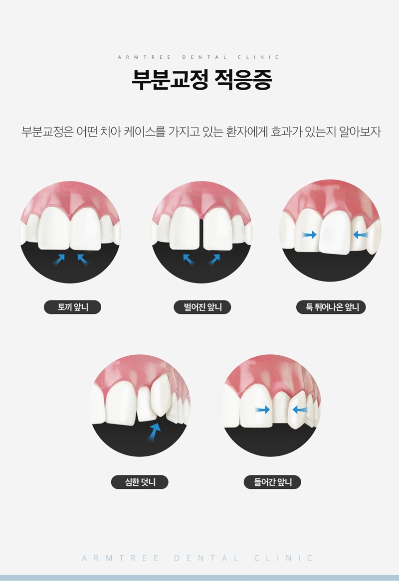 벌어진앞니부분교정 후기 신논현역 아름드리치과는 관련 이미지 6