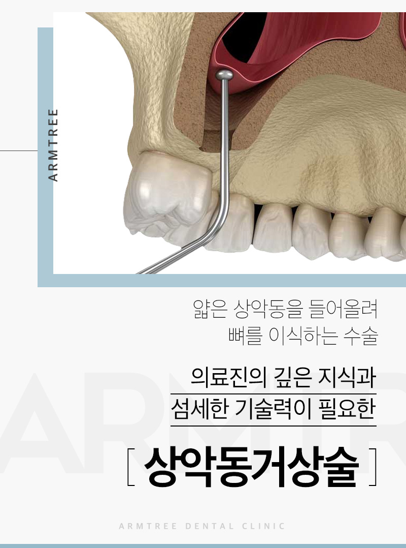 임플란트재수술 상악동거상술 부작용 케이스 진료일기 관련 이미지 1