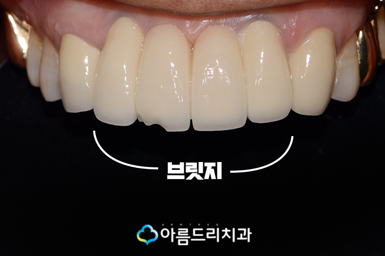 앞니 브릿지가 깨졌어요 치과치료 관련 이미지 3