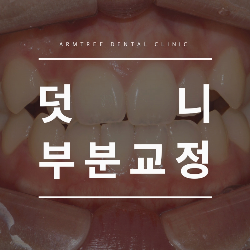 덧니부분교정 아름드리치과에서 확실하게 관련 이미지 1