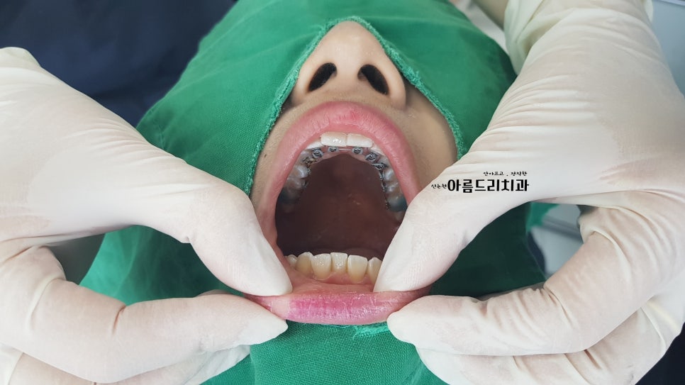 설측교정_신논현역 치과_야간진료 관련 이미지 5