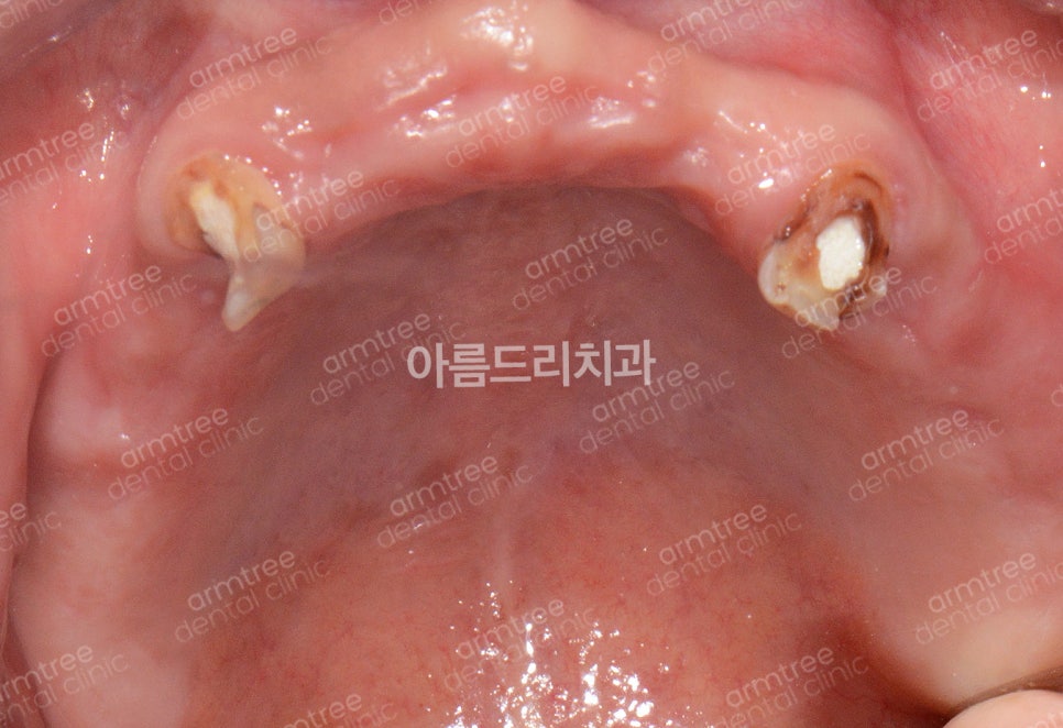 전체임플란트 전악임플란트 전후 아름드리치과 진료일기 관련 이미지 6