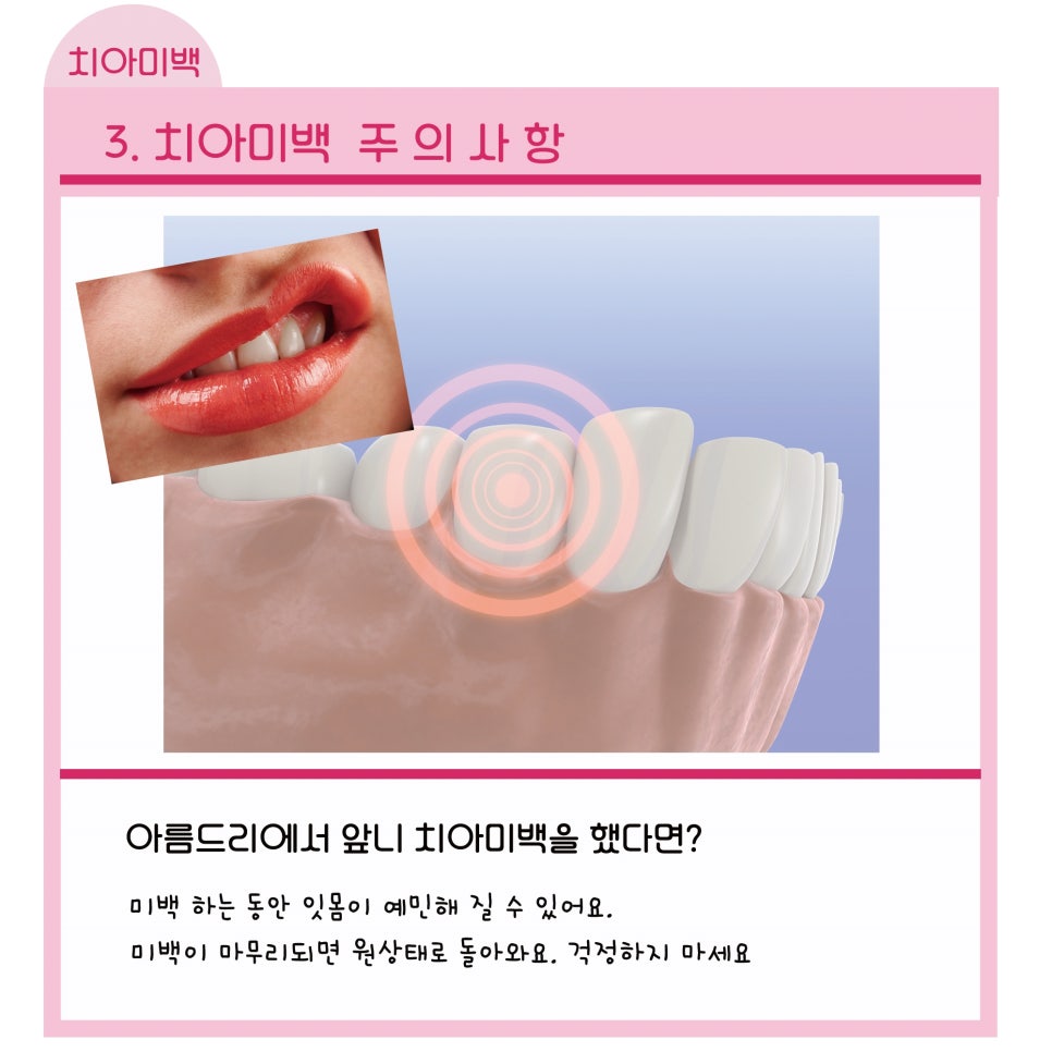 신논현역치과_치아미백 주의사항_아름드리치과 관련 이미지 7