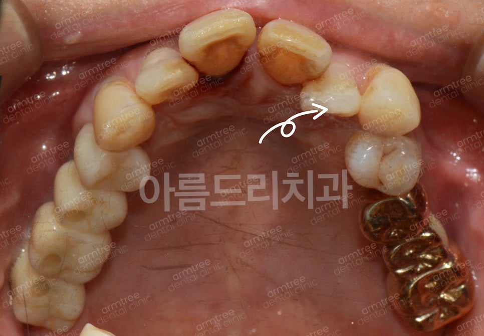 임플란트가 무조건 최선은 아니다! 아름드리치과 진료일기 관련 이미지 4