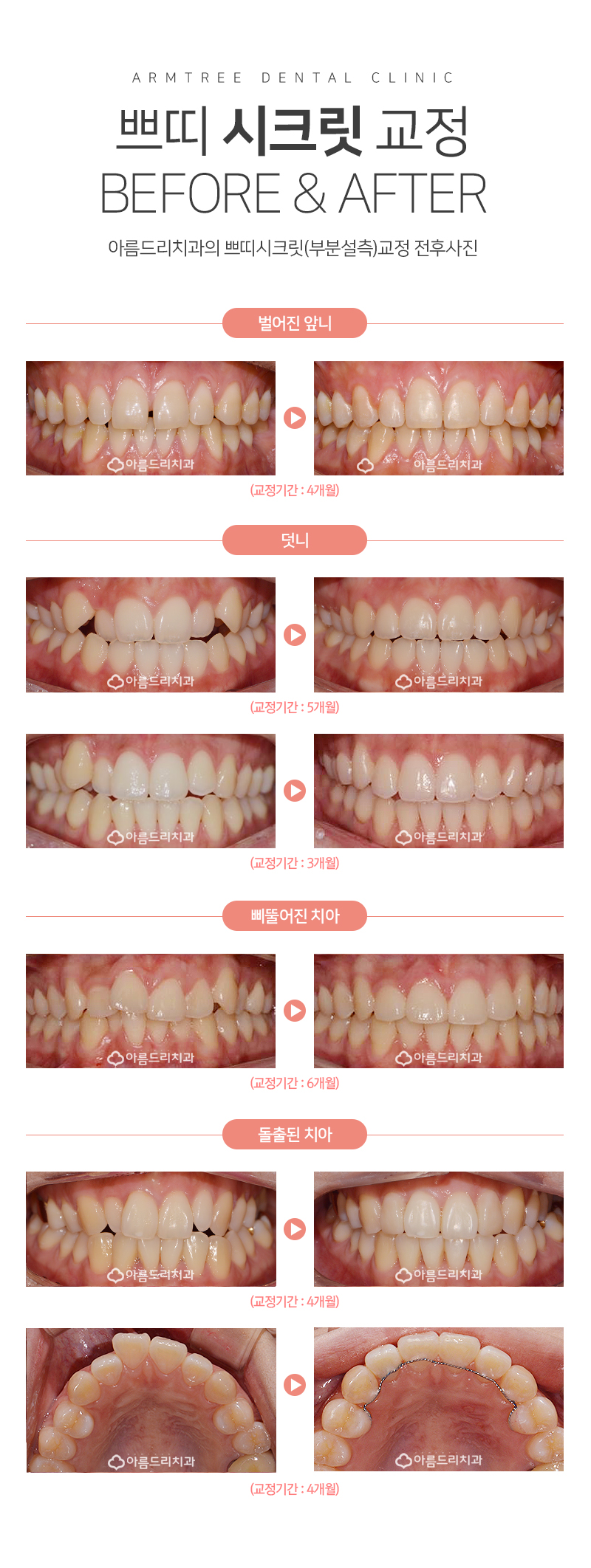 드라큘라이빨 송곳니교정 부분교정후기 관련 이미지 13
