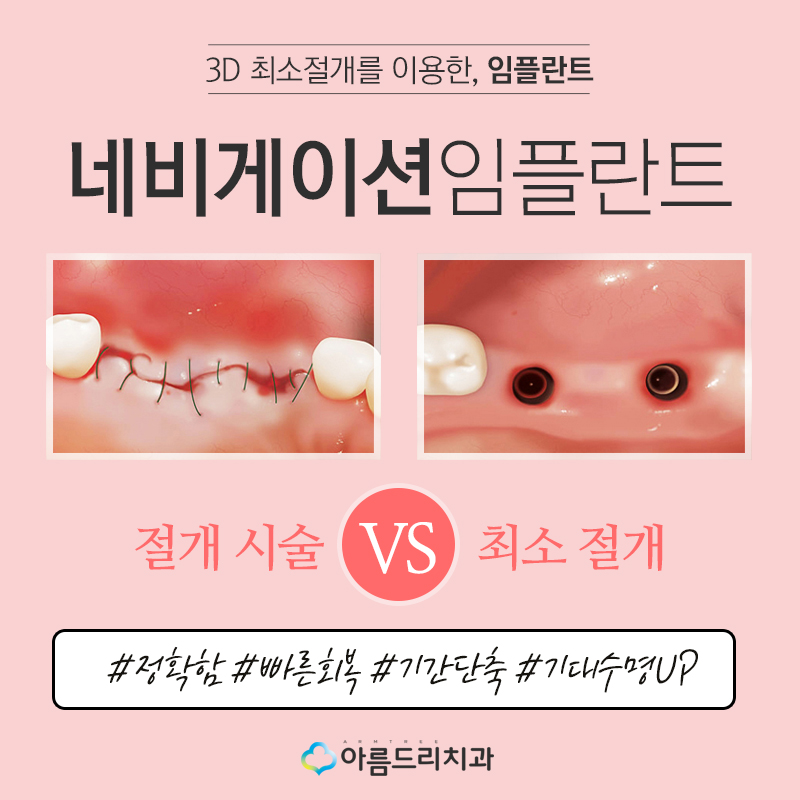 보철치료 임플란트후기 대만족! 관련 이미지 5