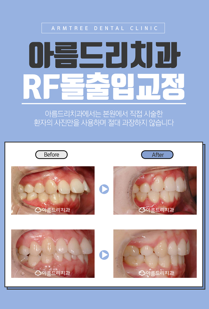 치아교정얼굴변화 어떠한가? 관련 이미지 8